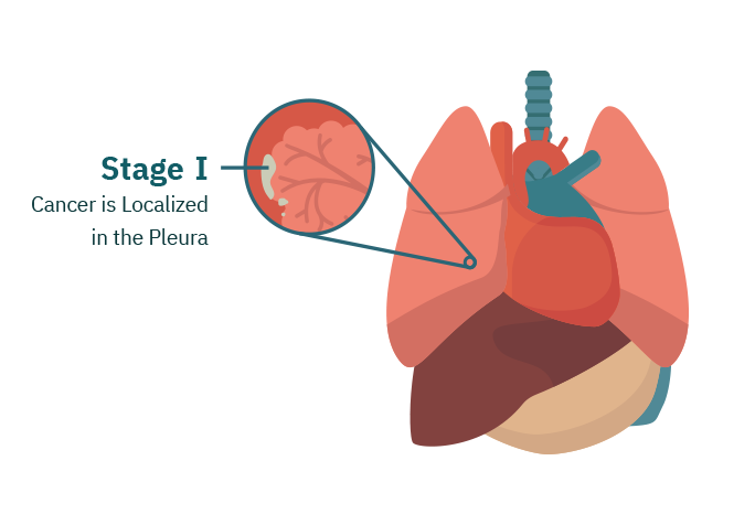 Stage 1 Mesothelioma