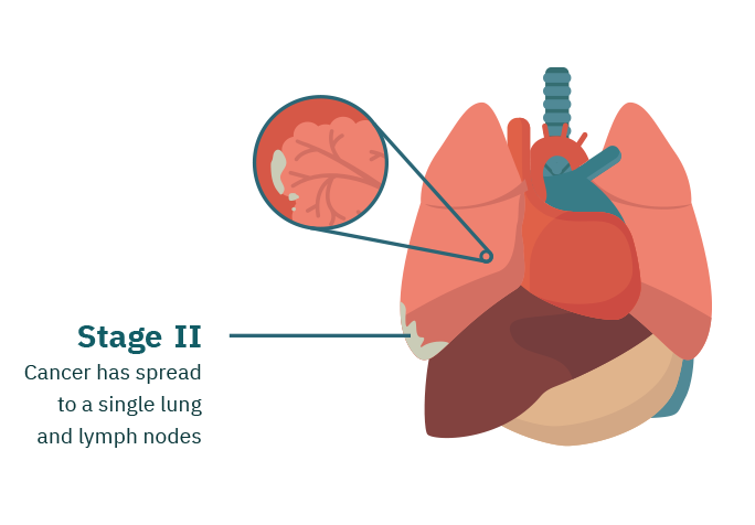 Stage 2 Mesothelioma