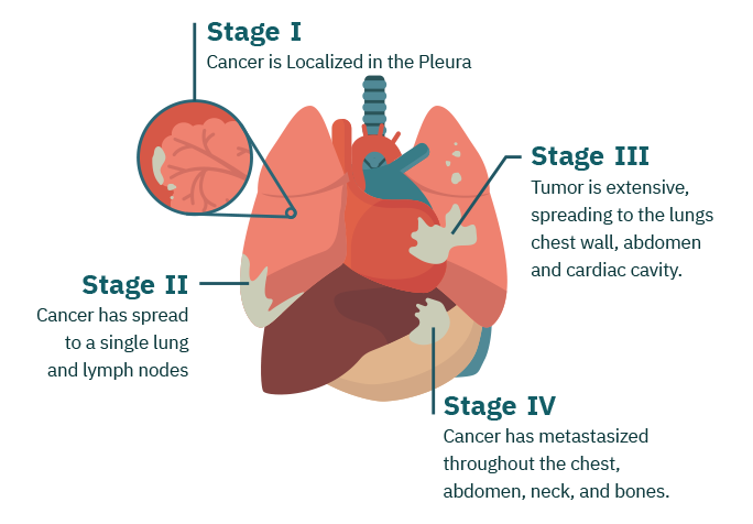 Mesothelioma Stages Asbestos Cancer Staging And Classification