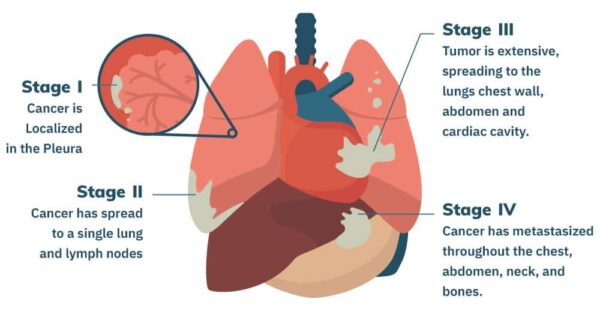 Mesothelioma Pictures