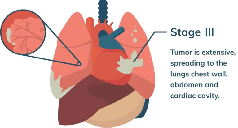 Mesothelioma Pictures Mesothelioma Com   Mesothelioma.com Stage3 768x414 