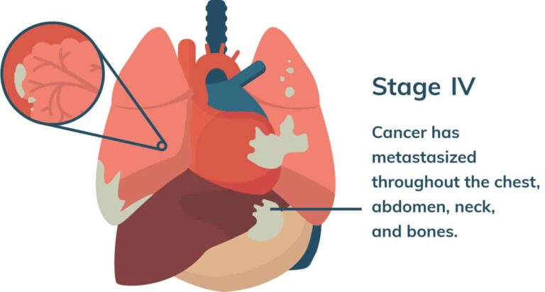 Mesothelioma Pictures | Mesothelioma.com