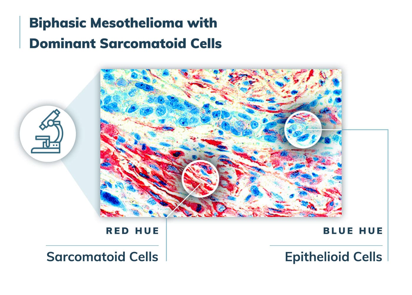 Sarcomatoid Mesothelioma | Prognosis, Treatment & Diagnosis