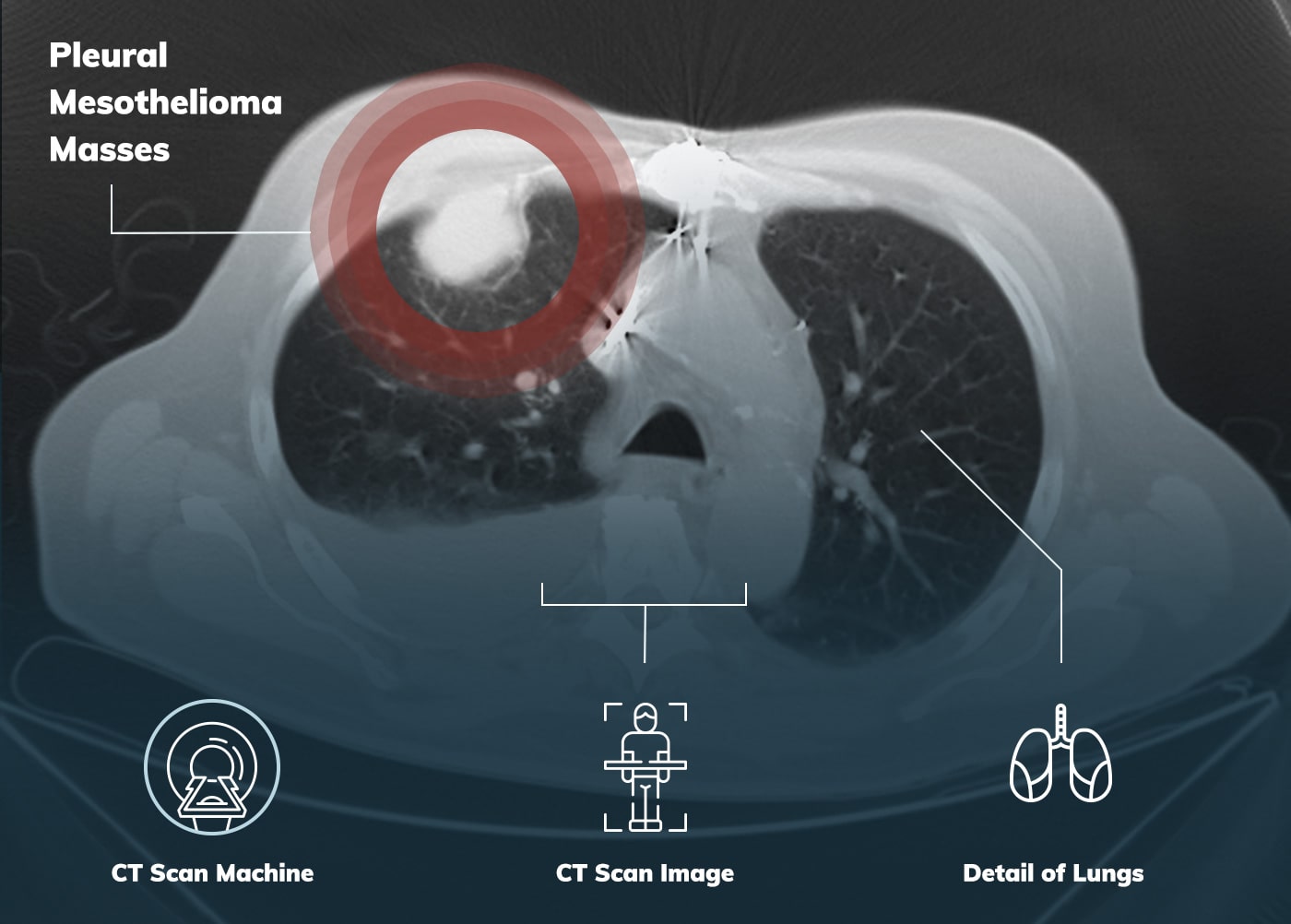 Pleural Mesothelioma | Treatment, Prognosis & Survival