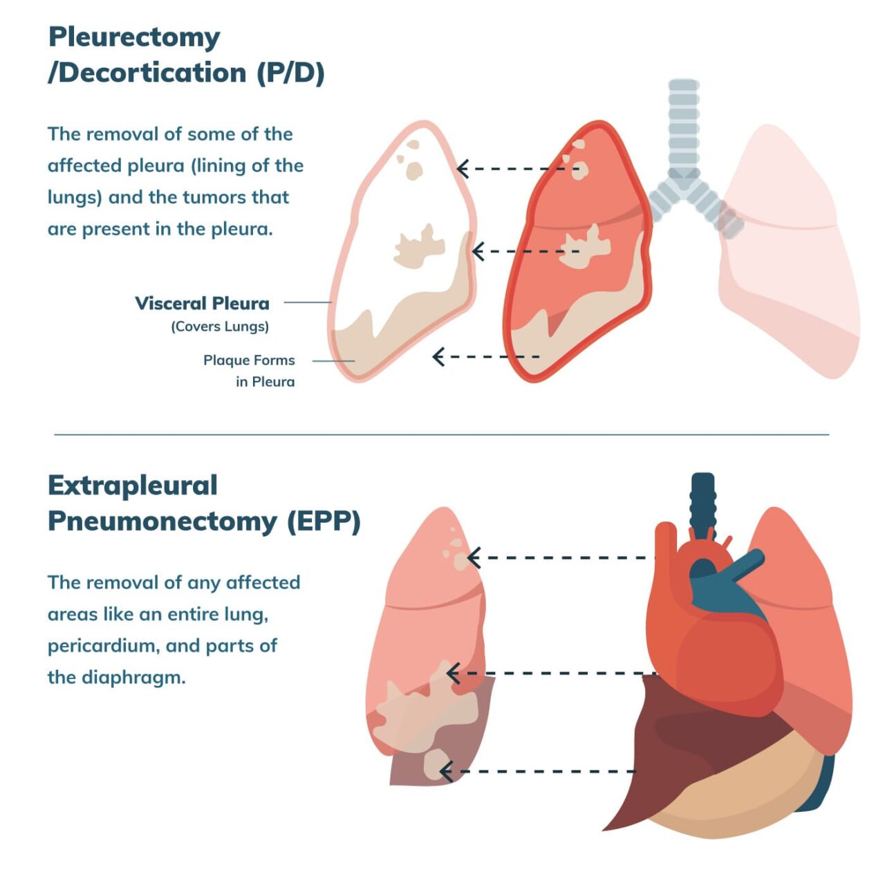 Epithelioid Mesothelioma Treatment, Prognosis & Diagnosis