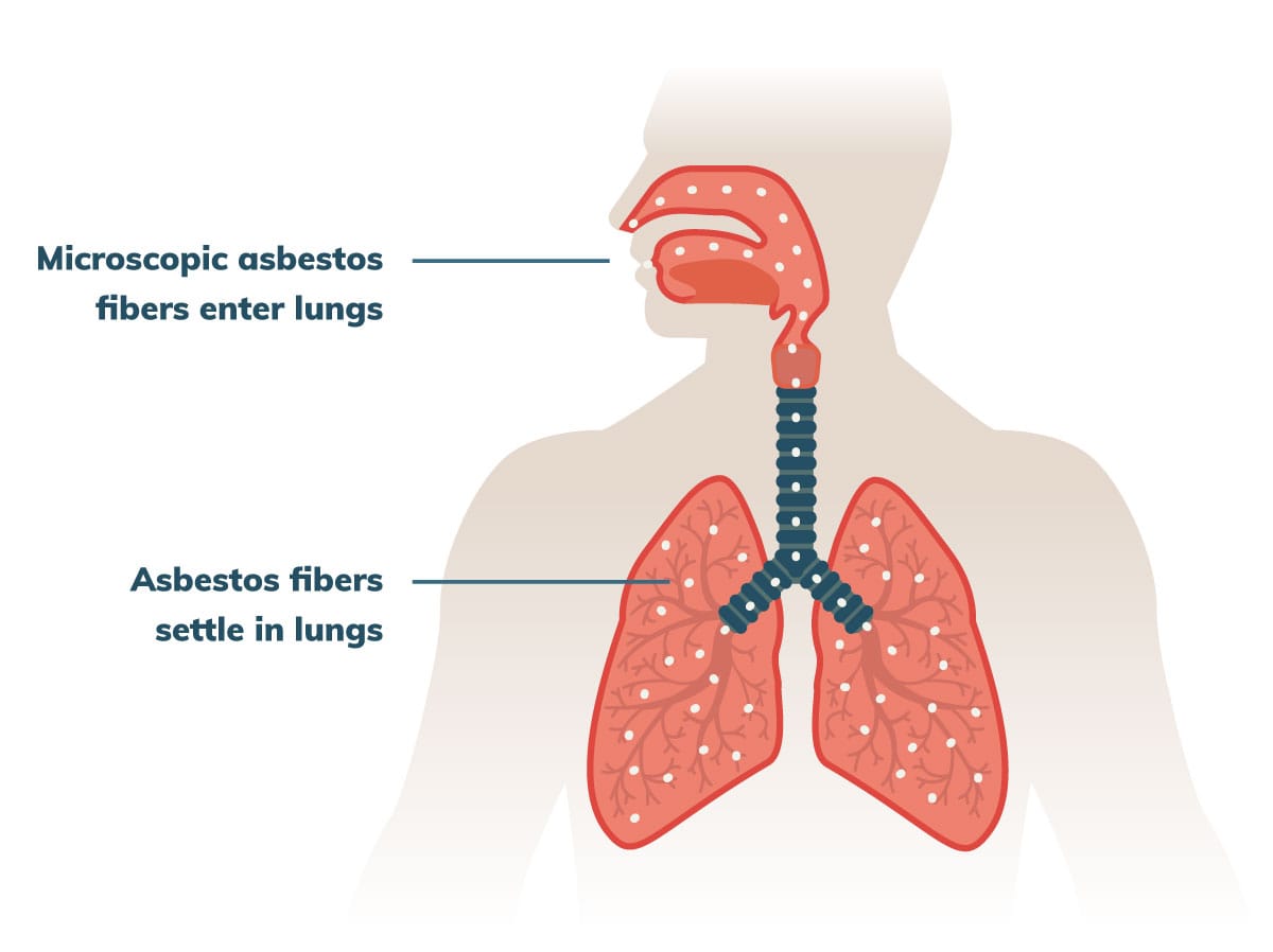 Mesothelioma Causes & Risk Factors | Mesothelioma.com